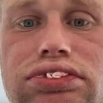 Βρετανός χωρίς δόντια μετά από εμφυτεύματα στην Τουρκία