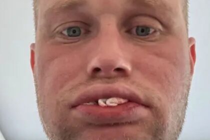 Βρετανός χωρίς δόντια μετά από εμφυτεύματα στην Τουρκία