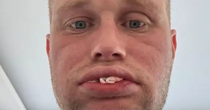 Βρετανός χωρίς δόντια μετά από εμφυτεύματα στην Τουρκία