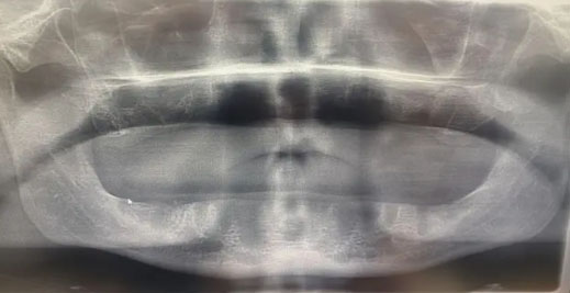 Βρετανός χωρίς δόντια μετά από εμφυτεύματα στην Τουρκία