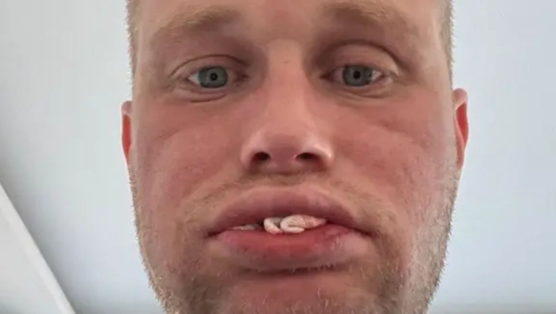 Βρετανός χωρίς δόντια μετά από εμφυτεύματα στην Τουρκία