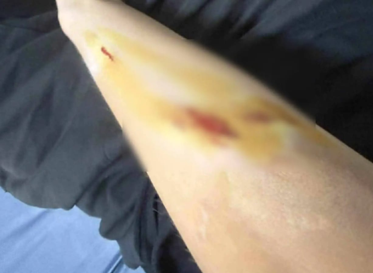 επίθεση σκύλου Μεσαρά 12χρονος τραυματίες