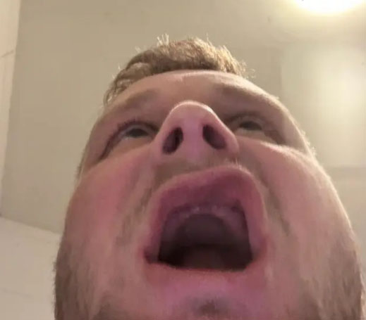 Βρετανός χωρίς δόντια μετά από εμφυτεύματα στην Τουρκία